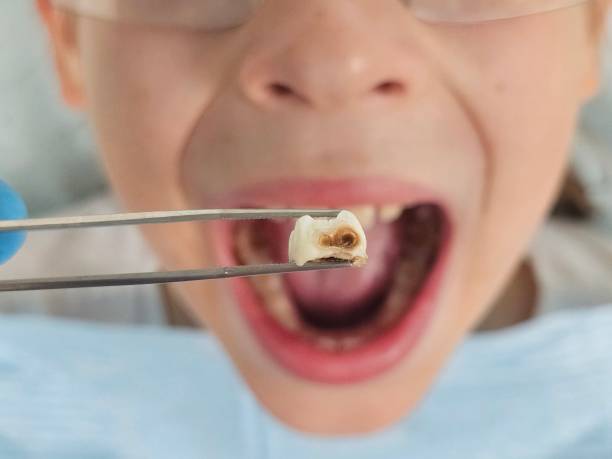 Best Emergency Dental Care for Broken or Chipped Teeth in Jacksonville, AL
